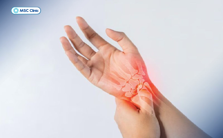Tổn thương từ quá trình thoái hóa cổ tay có thể gây viêm và dẫn đến tràn dịch khớp cổ tay