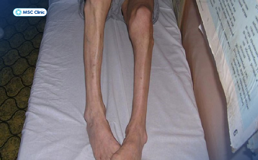 Tràn dịch khớp cổ chân không được điều trị đúng cách gây nguy cơ teo cơ nghiêm trọng