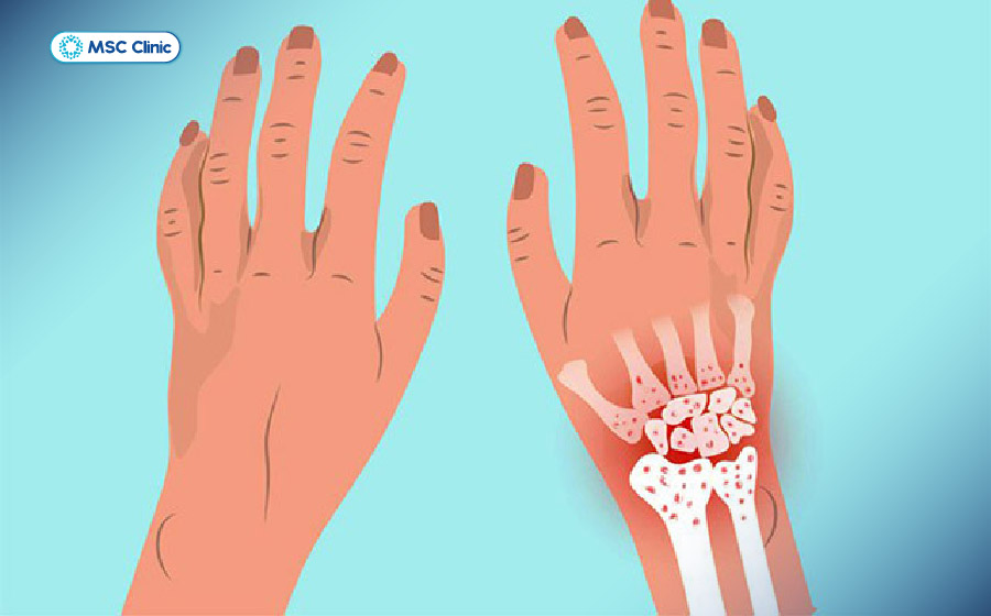 Tràn dịch khớp cổ tay là một biểu hiện cho thấy tình trạng viêm trong khớp đang diễn ra