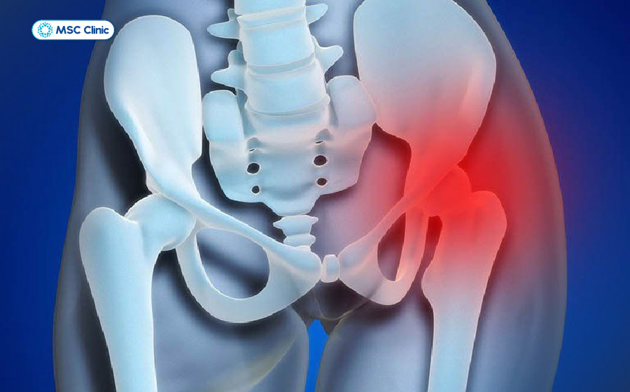 Tràn dịch khớp háng thường gây cảm giác đau ở vùng bẹn Tràn dịch khớp háng thường gây cảm giác đau ở vùng bẹn