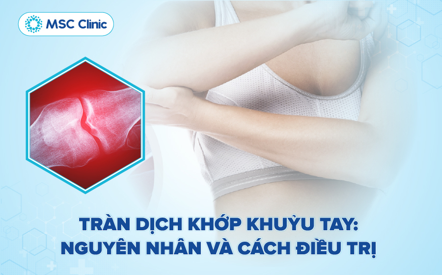 Tràn dịch khớp khuỷu tay có thể chữa khỏi không? Tìm hiểu trong bài viết sau Tràn dịch khớp khuỷu tay có thể chữa khỏi không? Tìm hiểu trong bài viết sau