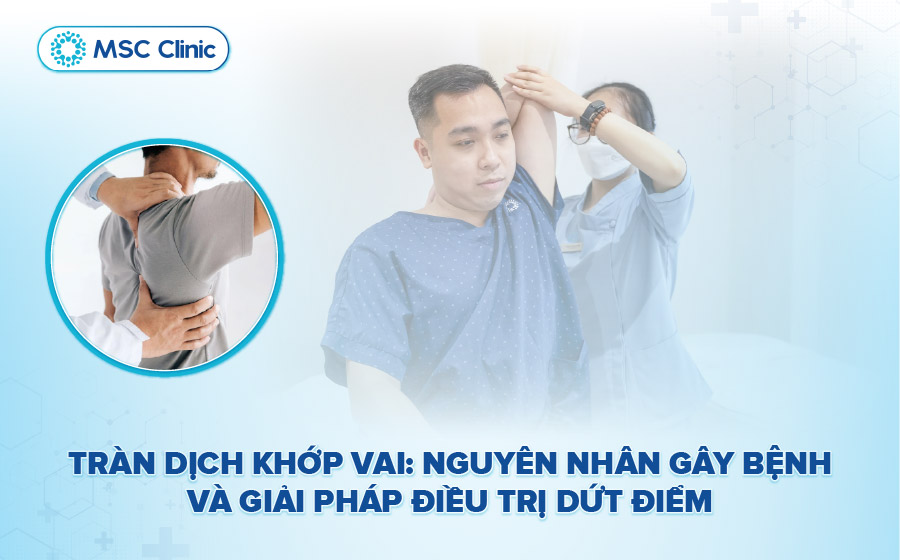 Tràn dịch khớp vai: 4 nguyên nhân và cách điều trị hiệu quả