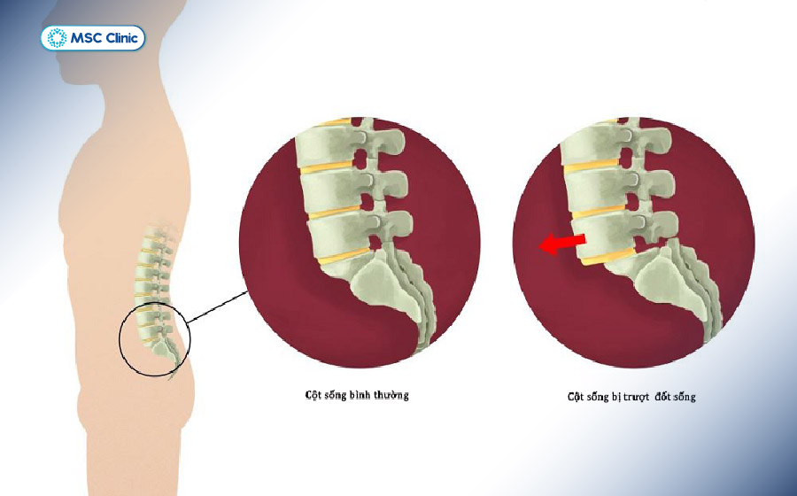 Trượt đốt sống là tình trạng nguy hiểm nếu không được xử lý đúng cách và kịp thời