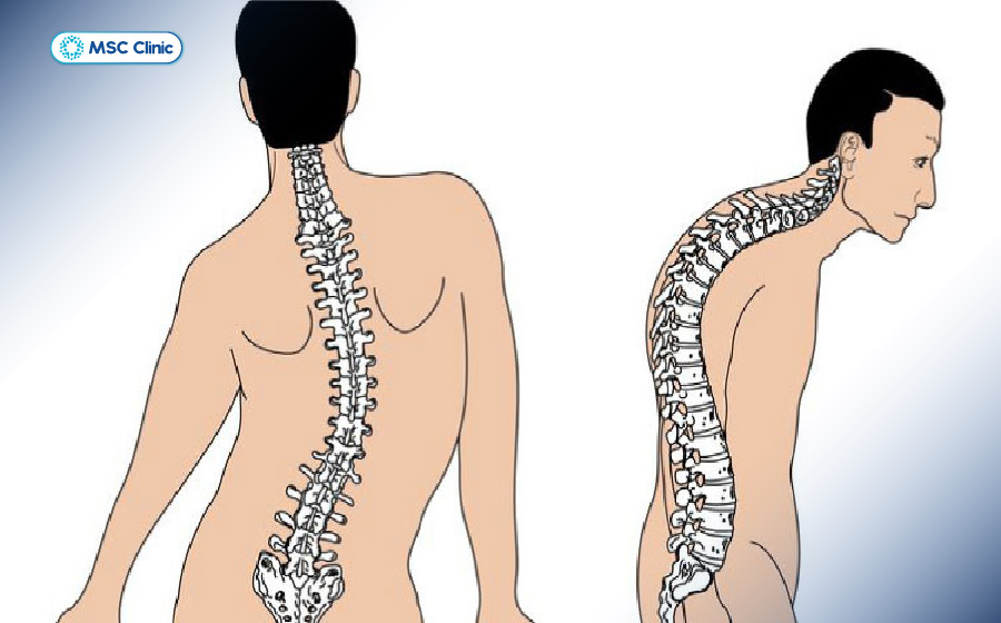 Trượt đốt sống nếu không được điều trị có thể gây biến dạng cột sống