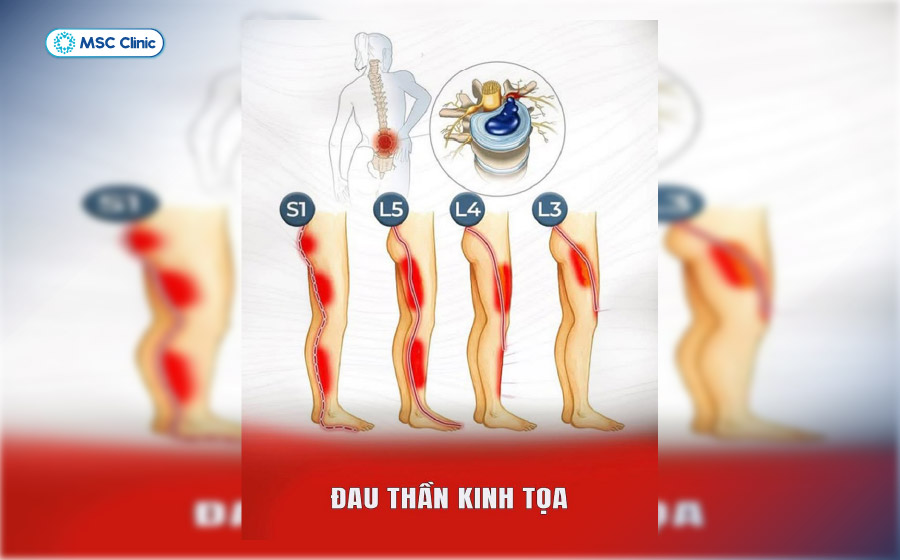 Vị trí đau có thể khác nhau tùy thuộc vào vị trí dây thần kinh bị chèn ép Vị trí đau có thể khác nhau tùy thuộc vào vị trí dây thần kinh bị chèn ép