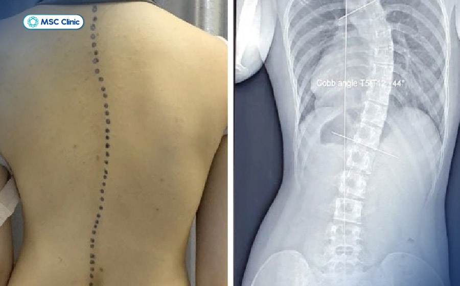 Xẹp đốt sống gây ra biến dạng cột sống nếu không được điều trị kịp thời