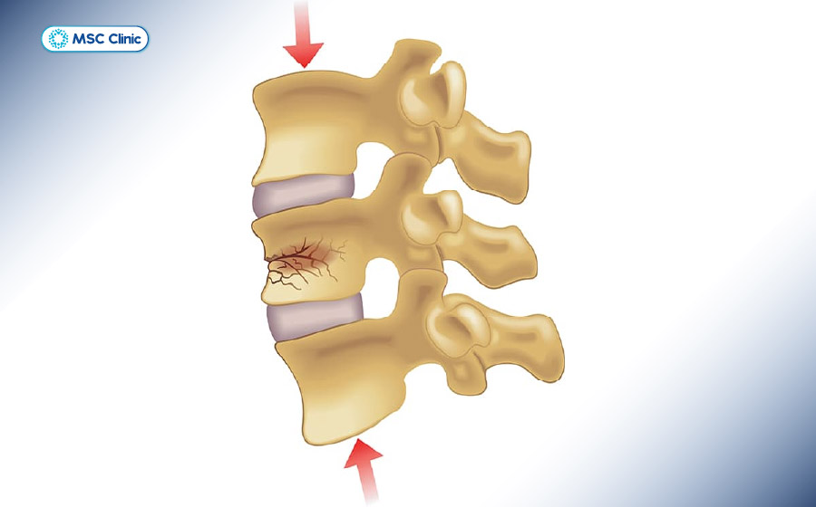Xẹp đốt sống xảy ra khi cấu trúc xương thân đốt sống bị phá vỡ, dẫn đến tình trạng lún sụt