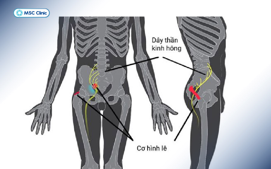 Xuất hiện cơn đau dữ dội, đau lan từ lưng xuống mông là dấu hiệu của đau thần kinh tọa Xuất hiện cơn đau dữ dội, đau lan từ lưng xuống mông là dấu hiệu của đau thần kinh tọa