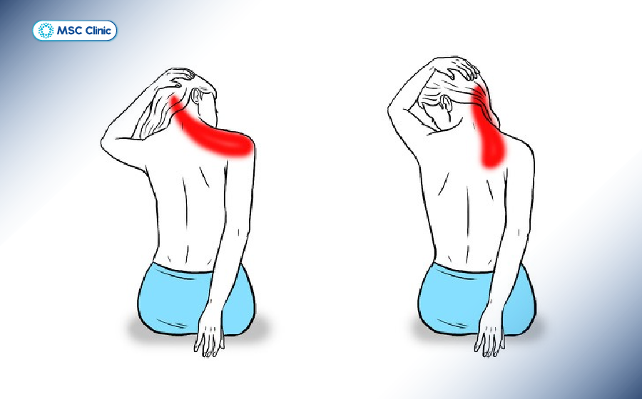 Bài tập kéo giãn cơ cổ giúp giảm căng cứng cơ