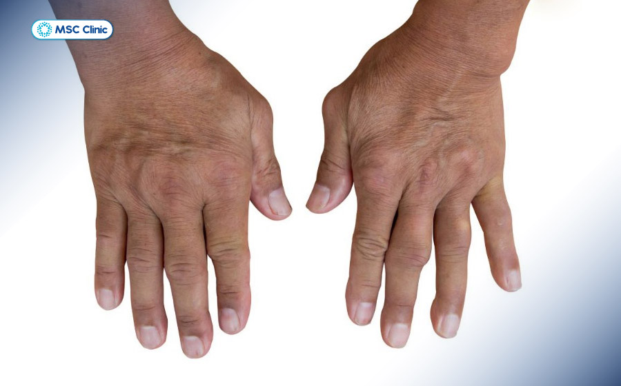 Bàn tay bị gout với các đốt ngón tay sưng cứng