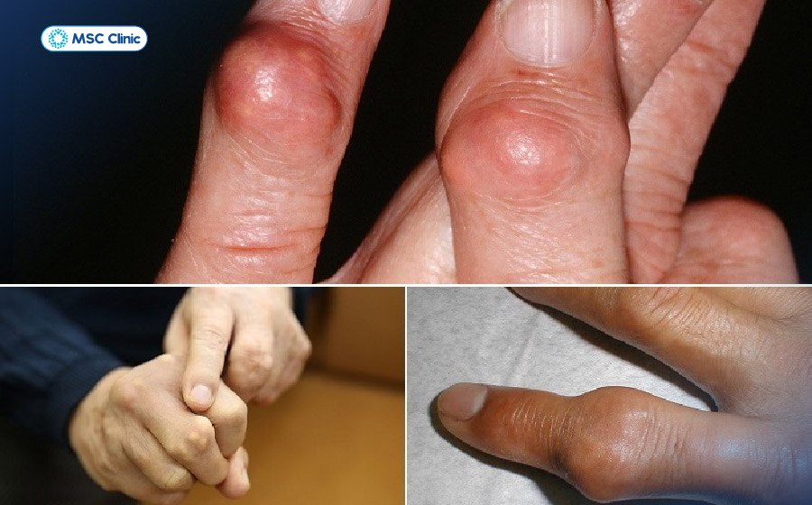 Bàn tay nổi cục u có thể là dấu hiệu thoái hóa khớp nặng hoặc do gout