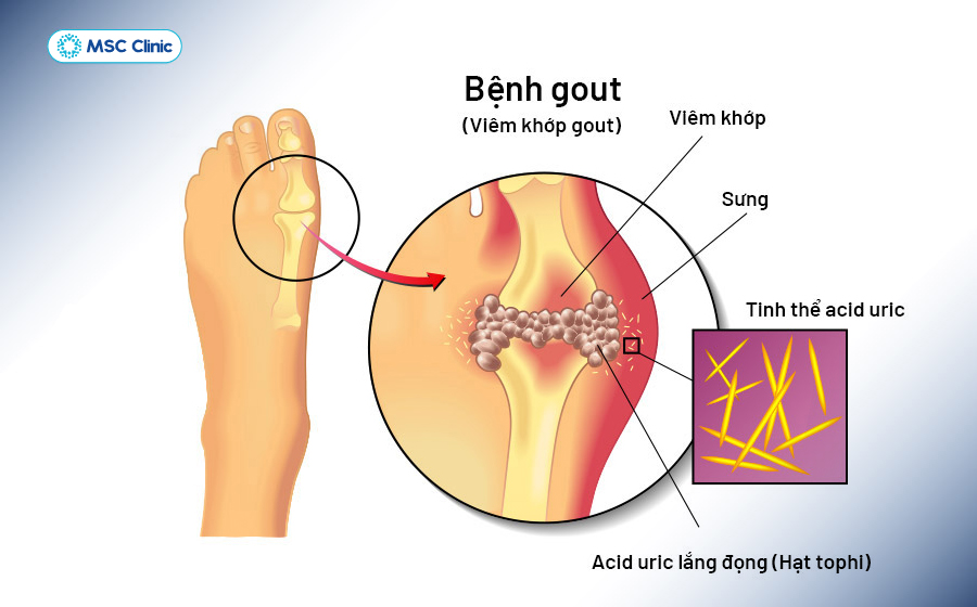 Bệnh gout gây đau nhức ngón chân cái Bệnh gout gây đau nhức ngón chân cái