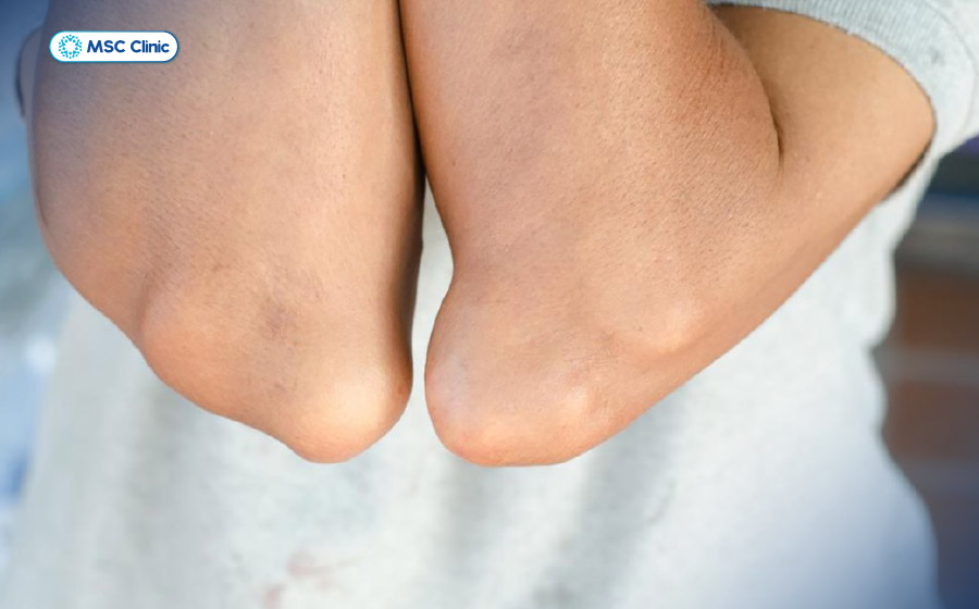 Bệnh gút có thể gây sưng, nóng đỏ và đau dữ dội tại khớp khuỷu tay