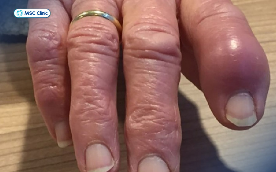 Bệnh nhân Gout thường bị sưng ở các đầu ngón tay hoặc ngón chân do tinh thể acid uric tích tụ trong khớp