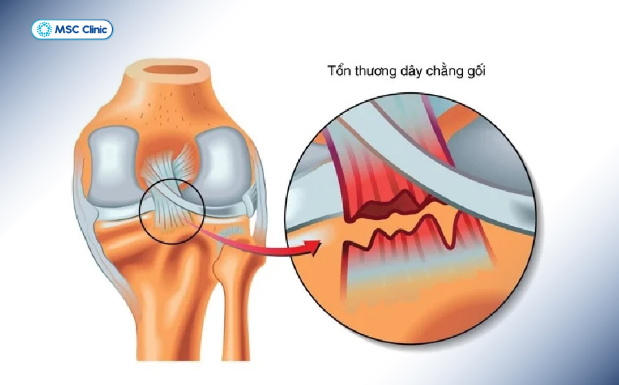 Bệnh nhân sẽ cảm thấy đau dữ dội khi bị đứt dây chằng khớp gối