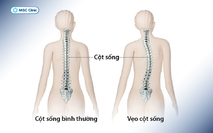 Biến dạng cột sống do thường xuyên vẹo sang một bên để giảm đau Biến dạng cột sống do thường xuyên vẹo sang một bên để giảm đau