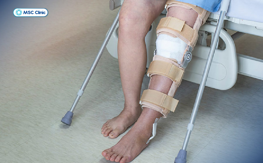 Bó bột hoặc bất động khớp quá lâu có thể làm tăng nguy cơ cứng khớp gối
