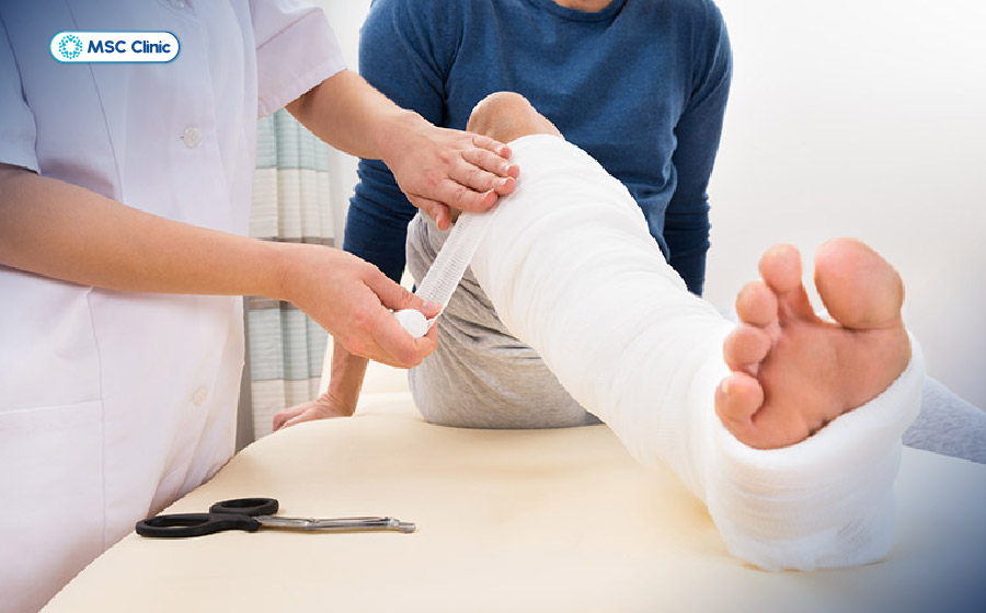 Bó bột hoặc nẹp cố định từ dưới gối xuống bàn chân trong điều trị bảo tồn gãy xương mác Bó bột hoặc nẹp cố định từ dưới gối xuống bàn chân trong điều trị bảo tồn gãy xương mác