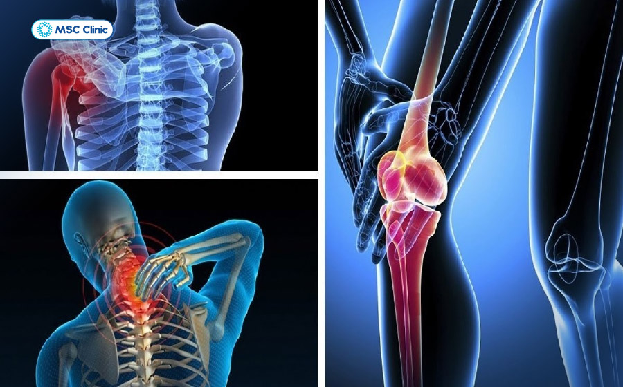 Các bệnh lý cơ xương khớp là nguyên nhân phổ biến gây ra nhức mỏi tay chân vào ban đêm Các bệnh lý cơ xương khớp là nguyên nhân phổ biến gây ra nhức mỏi tay chân vào ban đêm