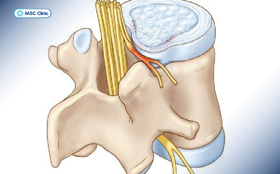 Chèn ép dây thần kinh do thoát vị đĩa đệm Chèn ép dây thần kinh do thoát vị đĩa đệm