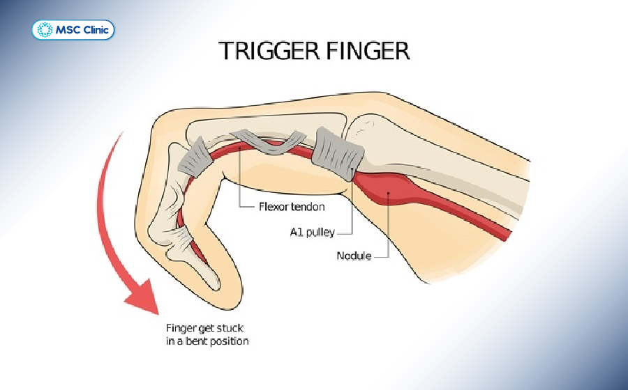 Cơ chế ngón tay cò súng xảy ra khi gân gấp bị kẹt tại ròng rọc A1, gây cảm giác bật cục hoặc khóa ngón