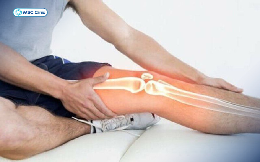 Cứng khớp gối khiến người bệnh khó co duỗi và ảnh hưởng đến khả năng vận động hàng ngày 