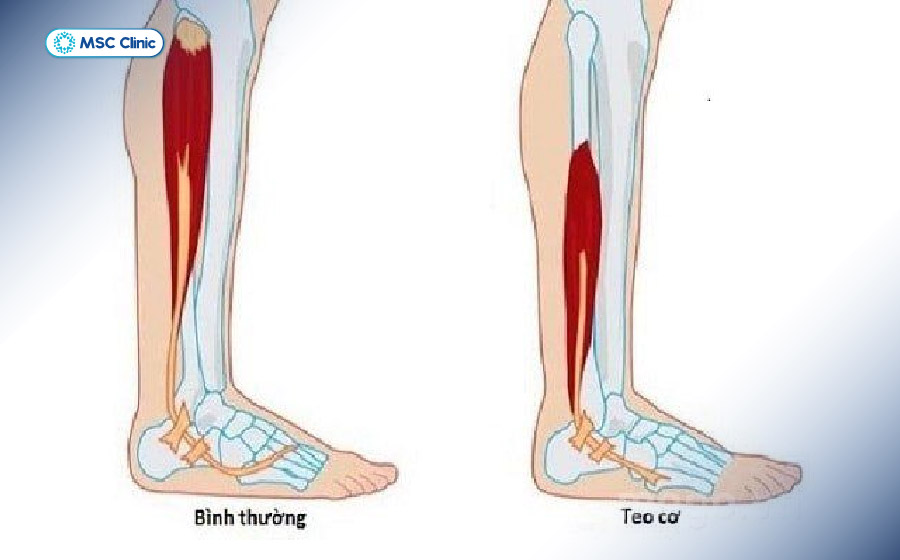 Cứng khớp gối không điều trị kịp thời có thể dẫn đến dính khớp và teo cơ 