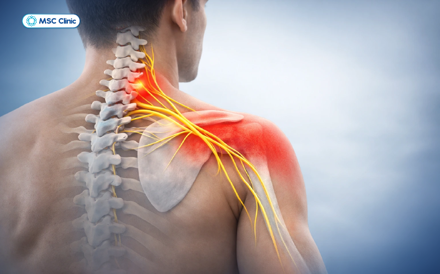Đau cổ vai gáy liên quan đến vùng cơ xương và dây thần kinh