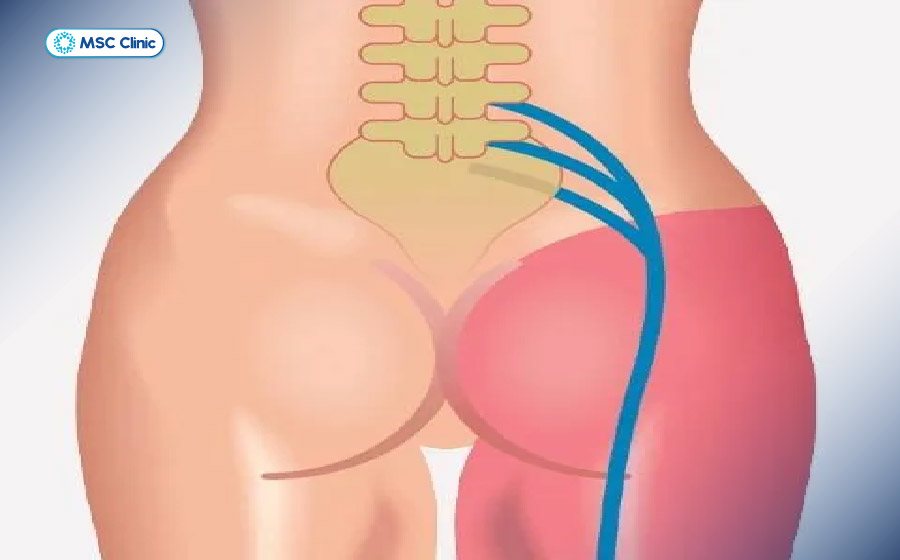 Đau dây thần kinh tọa gây đau lan xuống mông và chân do chèn ép thần kinh tại cột sống Đau dây thần kinh tọa gây đau lan xuống mông và chân do chèn ép thần kinh tại cột sống