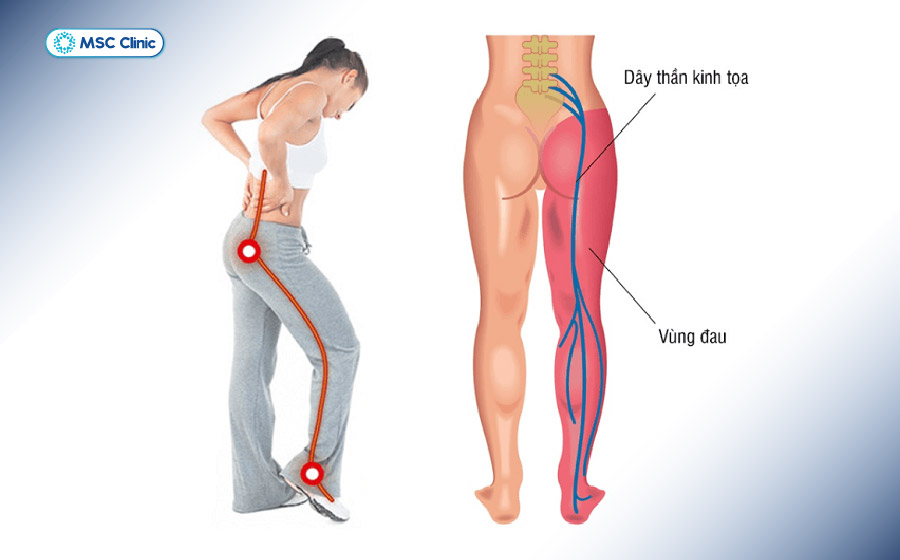 Đau dọc dây thần kinh toạ lan toả là một trong những dấu hiệu phổ biến của hội chứng thắt lưng hông Đau dọc dây thần kinh toạ lan toả là một trong những dấu hiệu phổ biến của hội chứng thắt lưng hông