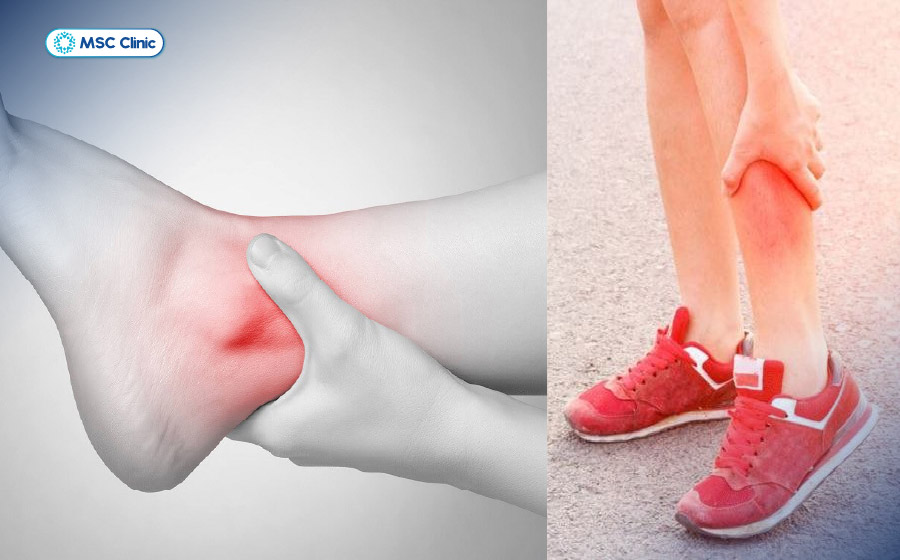 Dấu hiệu điển hình của gãy xương mác là đau nhói mặt ngoài cẳng chân và quanh mắt cá ngoài Dấu hiệu điển hình của gãy xương mác là đau nhói mặt ngoài cẳng chân và quanh mắt cá ngoài