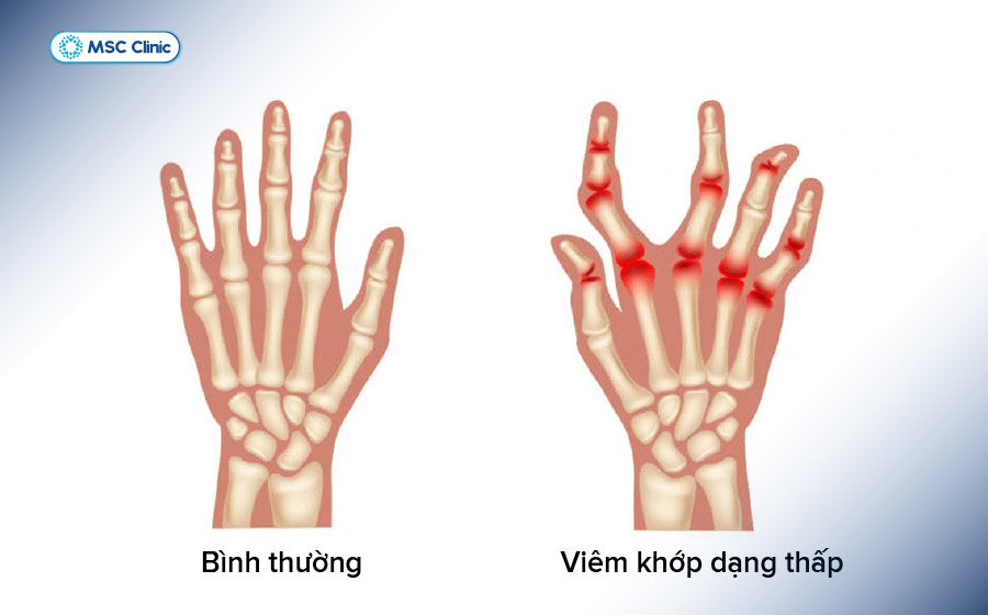 Đau khớp ngón tay giữa do viêm khớp dạng thấp 