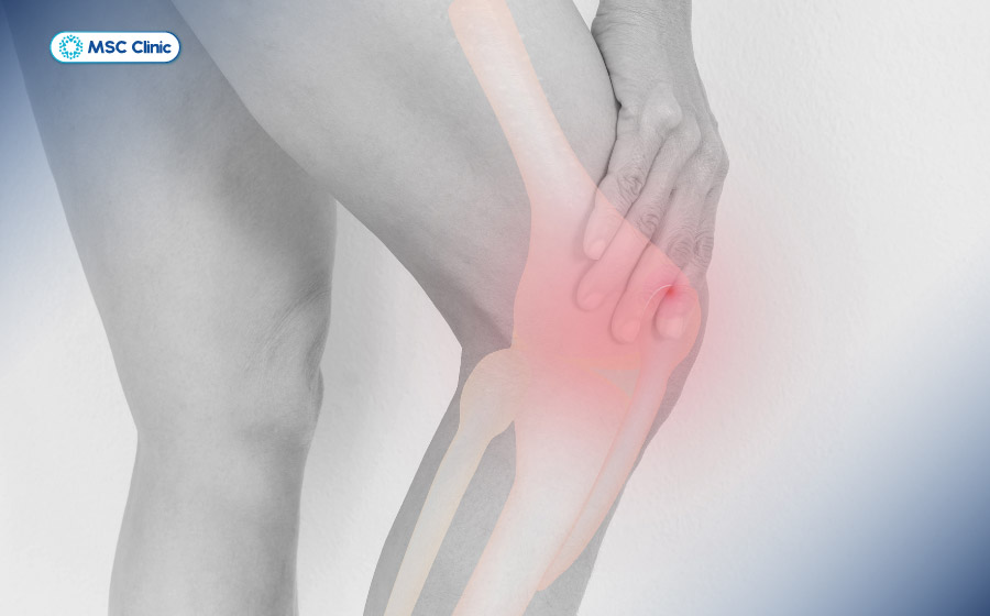 Đau vùng đầu gối hoặc đau dữ dội, cứng khớp gối là dấu hiệu của gãy mâm chày