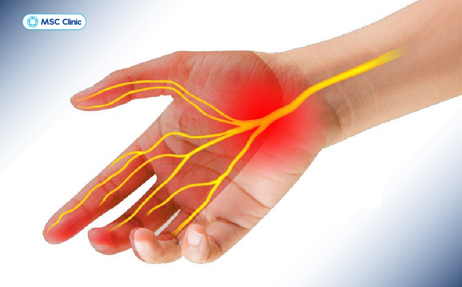 Dây thần kinh đi qua các vị trí hẹp như cổ tay bị áp lực kéo dài gây cảm giác tê, châm chích ở đầu ngón tay