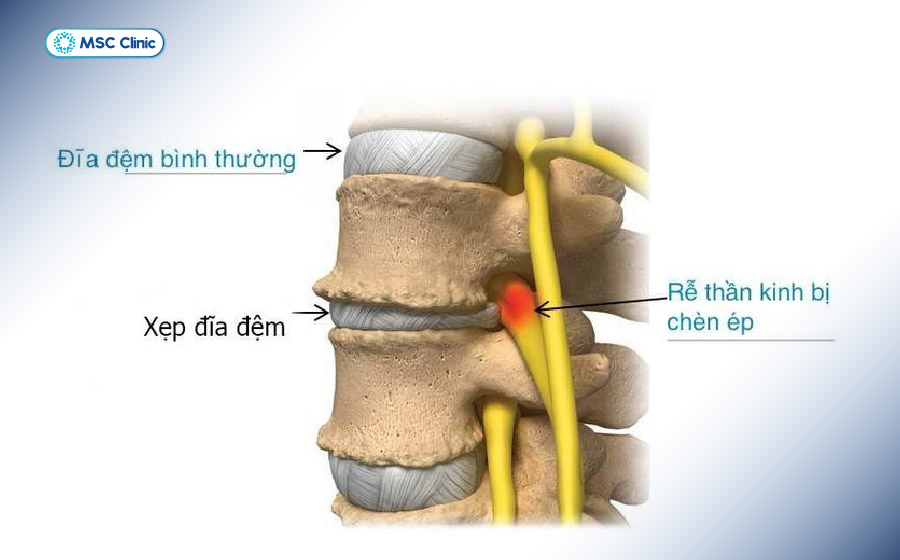 Đĩa đệm bị xẹp làm khoảng cách giữa các đốt sống thu hẹp, tăng nguy cơ chèn ép thần kinh và thoái hóa cột sống Đĩa đệm bị xẹp làm khoảng cách giữa các đốt sống thu hẹp, tăng nguy cơ chèn ép thần kinh và thoái hóa cột sống
