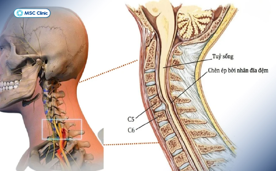 Đối với thoát vị đĩa đệm có chèn ép tuỷ sống, thời gian phục hồi sẽ mất đến vài tháng hoặc vài năm 