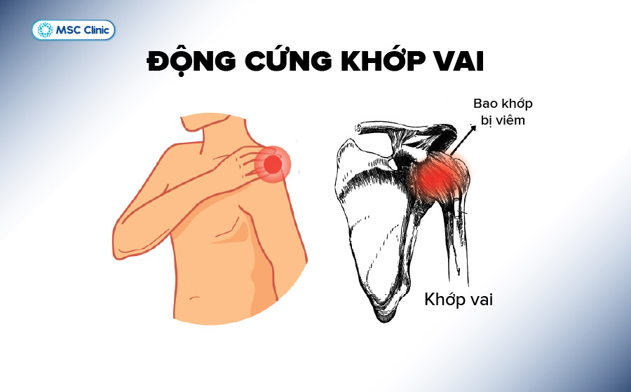 Đông cứng khớp vai khiến hạn chế vận động do bao khớp bị viêm và dày lên Đông cứng khớp vai khiến hạn chế vận động do bao khớp bị viêm và dày lên