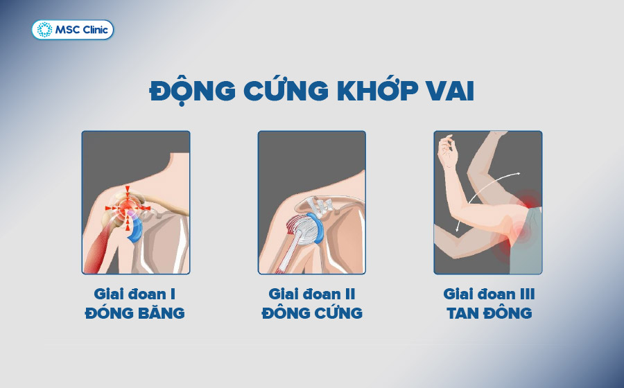 Đông cứng khớp vai tiến triển qua 3 giai đoạn chính Đông cứng khớp vai tiến triển qua 3 giai đoạn chính