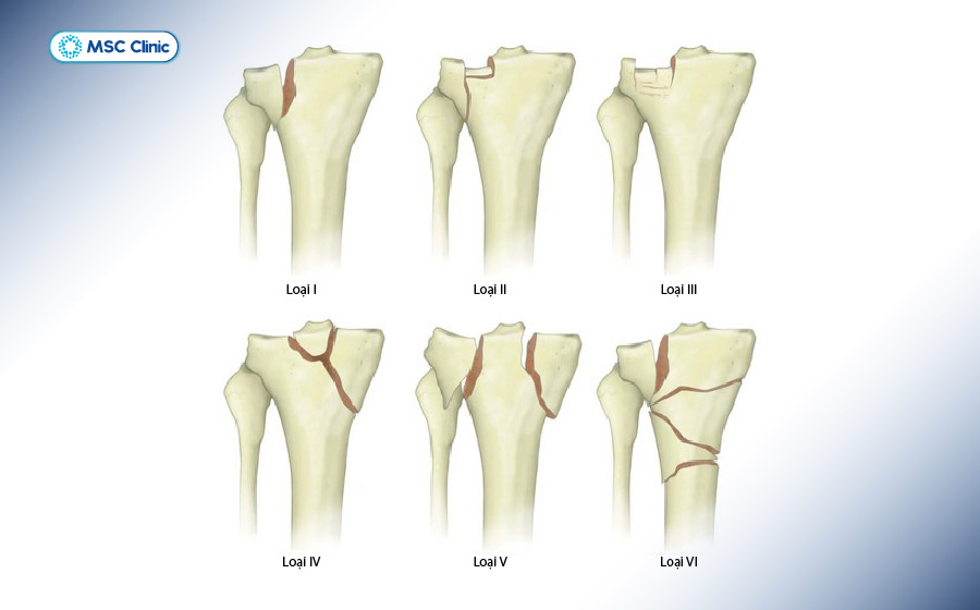 Gãy mâm chày được chia làm 6 loại theo hệ thống Schatzker
