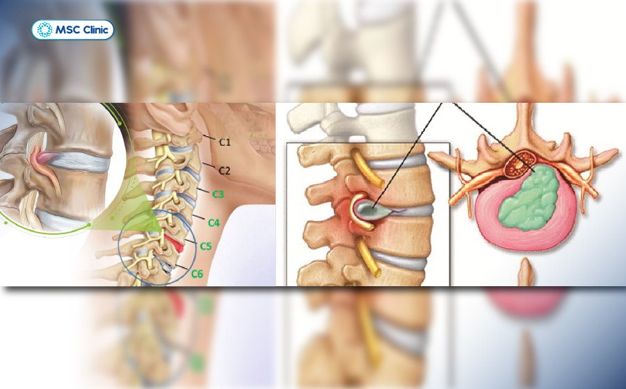 Giải đáp chi tiết thoát vị đĩa đệm bao lâu thì khỏi