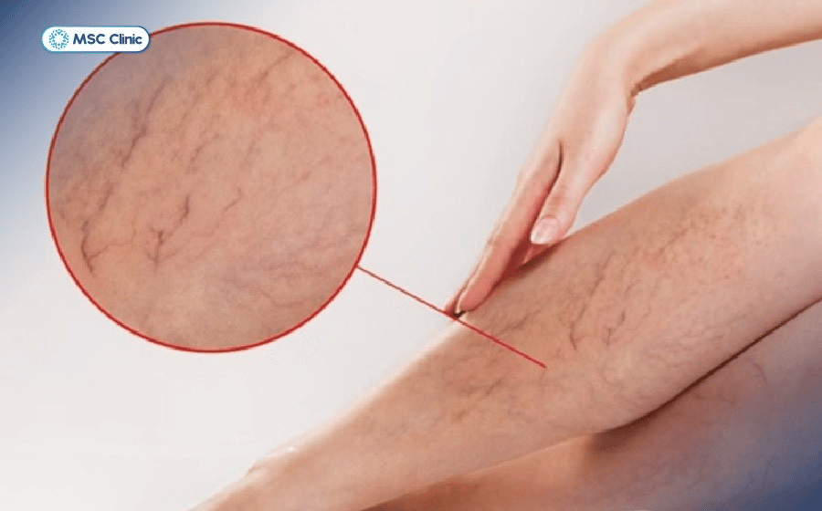 Giãn tĩnh mạch thường xảy ra với những người có tình chất công việc cần đứng lâu, đứng nhiều giờ liên tục Giãn tĩnh mạch thường xảy ra với những người có tình chất công việc cần đứng lâu, đứng nhiều giờ liên tục