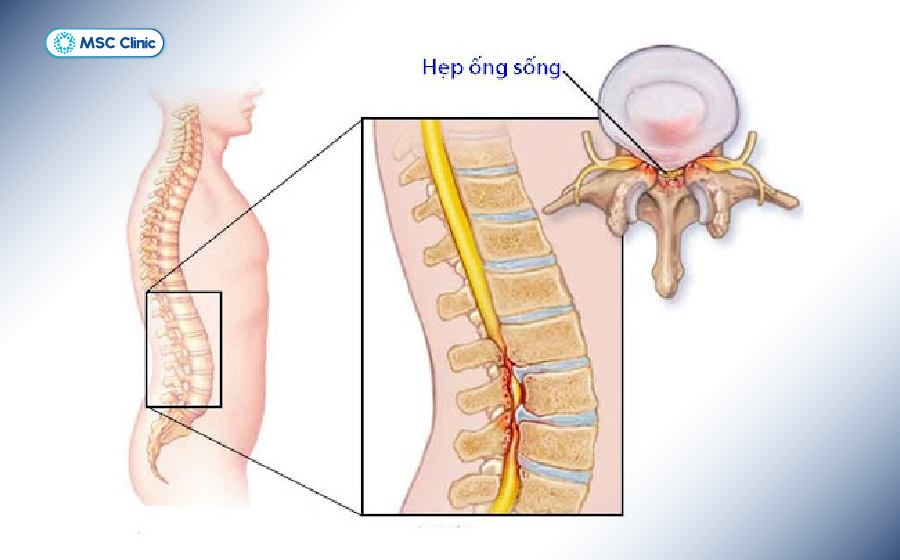 Hẹp ống sống gây chèn ép tuỷ sống và rễ thần kinh, dẫn đến các cơn đau tại thắt lưng và hông Hẹp ống sống gây chèn ép tuỷ sống và rễ thần kinh, dẫn đến các cơn đau tại thắt lưng và hông