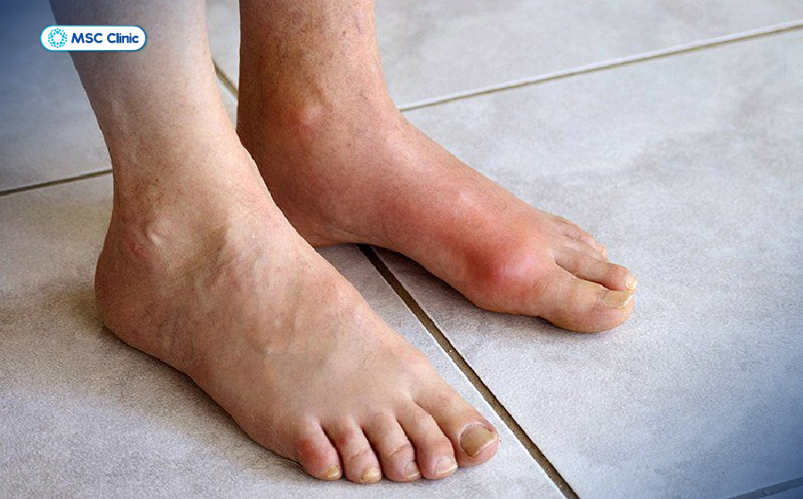 Hình ảnh bệnh nhân bị Gout khiến bàn chân sưng nề đau nhức