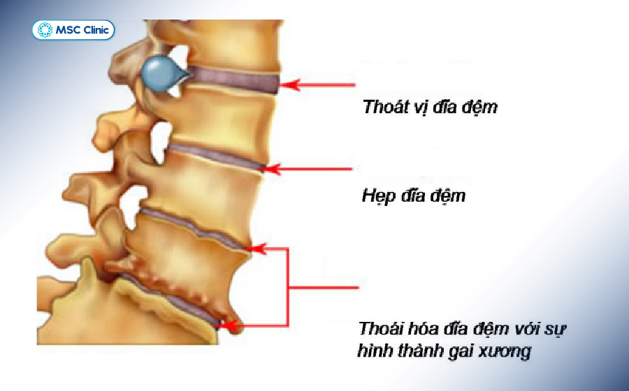 Hình ảnh chi tiết về thoái hoá cột sống cổ và thoát vị đĩa đệm đốt sống cổ Hình ảnh chi tiết về thoái hoá cột sống cổ và thoát vị đĩa đệm đốt sống cổ