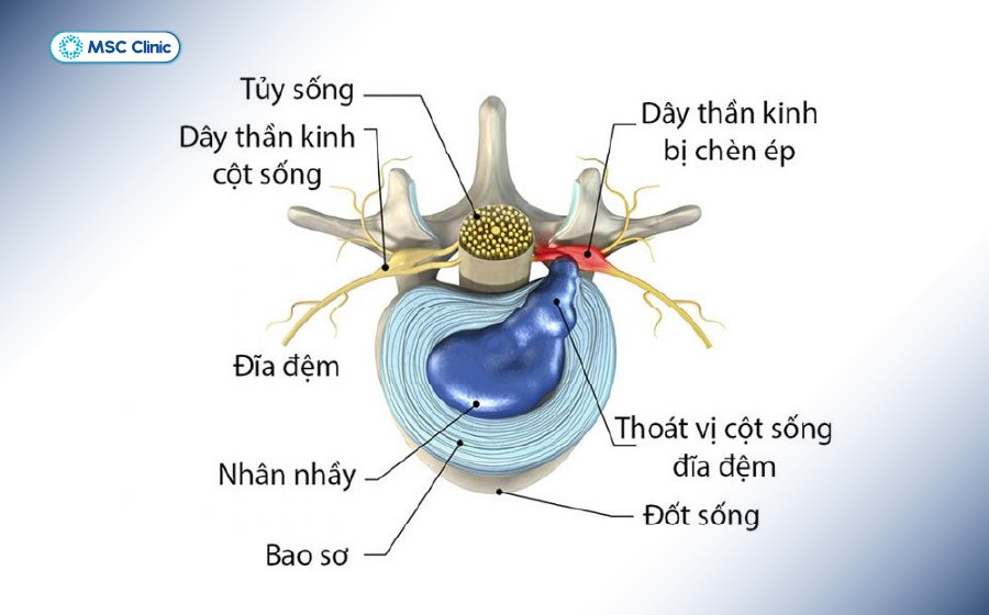 Hình mô phỏng nhân nhầy đĩa đệm thoát ra ngoài chèn ép dây thần kinh