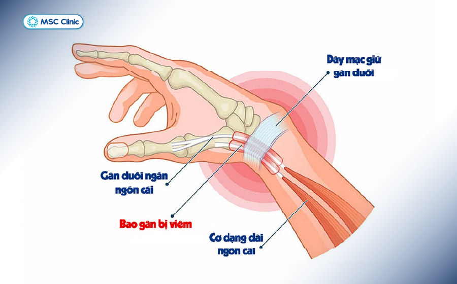 Hội chứng De Quervain thường gặp ở người làm công việc sử dụng tay lặp đi lặp lại