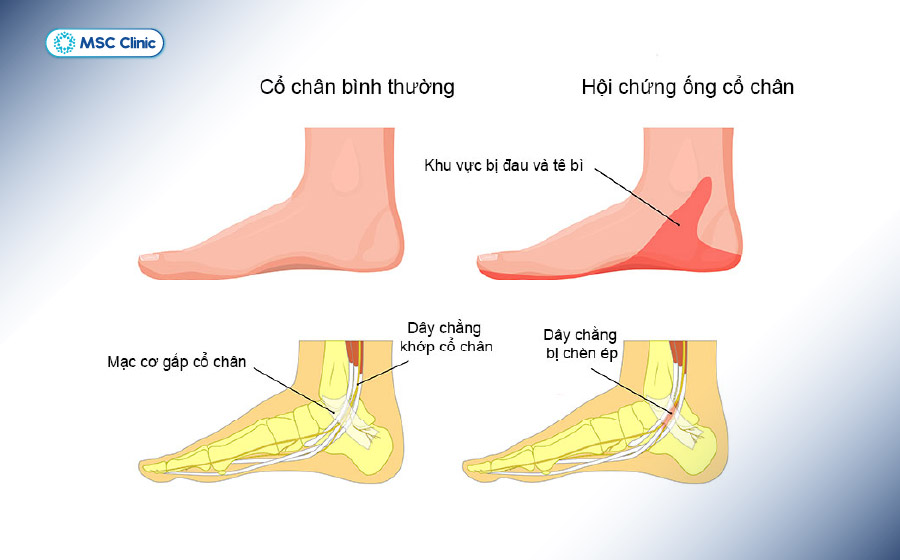 Hội chứng ống cổ chân gây chèn ép dây thần kinh dẫn đến tê lòng bàn chân và ngón chân cái