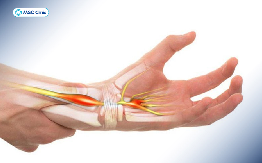 Hội chứng ống cổ tay do chèn ép dây thần kinh giữa, dẫn đến tình trạng tê tay