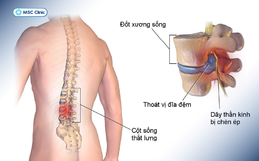 Hội chứng thắt lưng hông thường do thoát vị đĩa đệm cột sống thắt lưng gây ra Hội chứng thắt lưng hông thường do thoát vị đĩa đệm cột sống thắt lưng gây ra