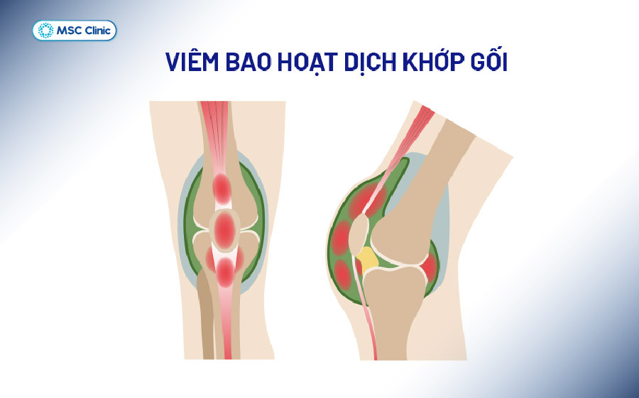 Khi bao hoạt dịch viêm nhiều, vùng đầu gối có thể sưng phồng rõ do dịch tích tụ bên trong khớp